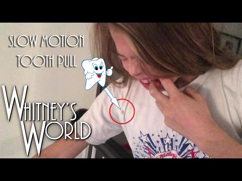Tooth Pulled Out in Slow Motion | Whitney