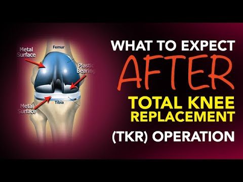 What To Expect After A Total Knee Replacement (TKR) Operation