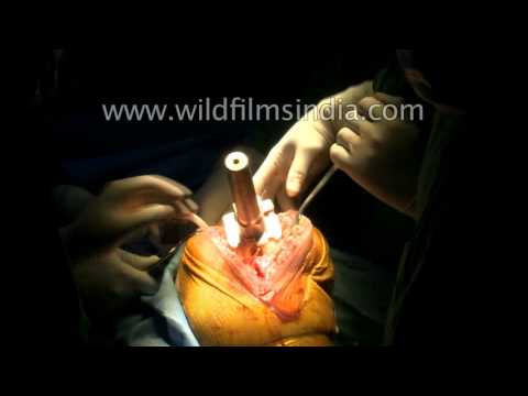 Complete Knee Replacement Surgery : watch the entire process